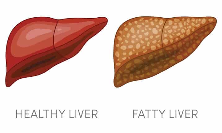 Fatty Liver