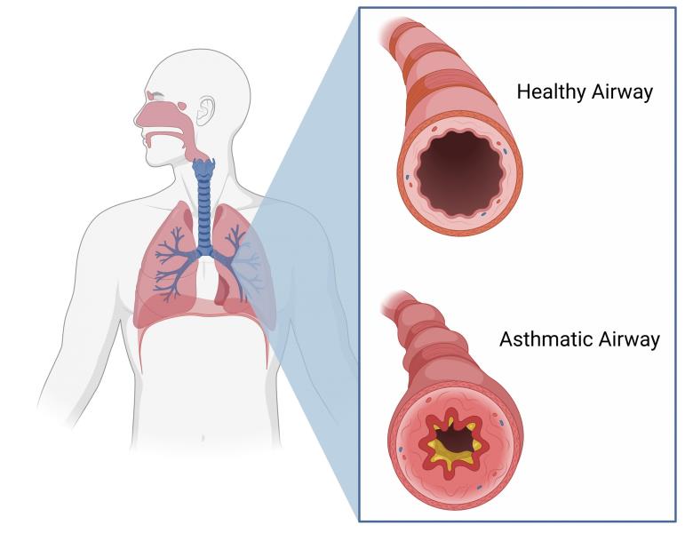 Asthma management & treatment - Dr. Debabrata Sarkar