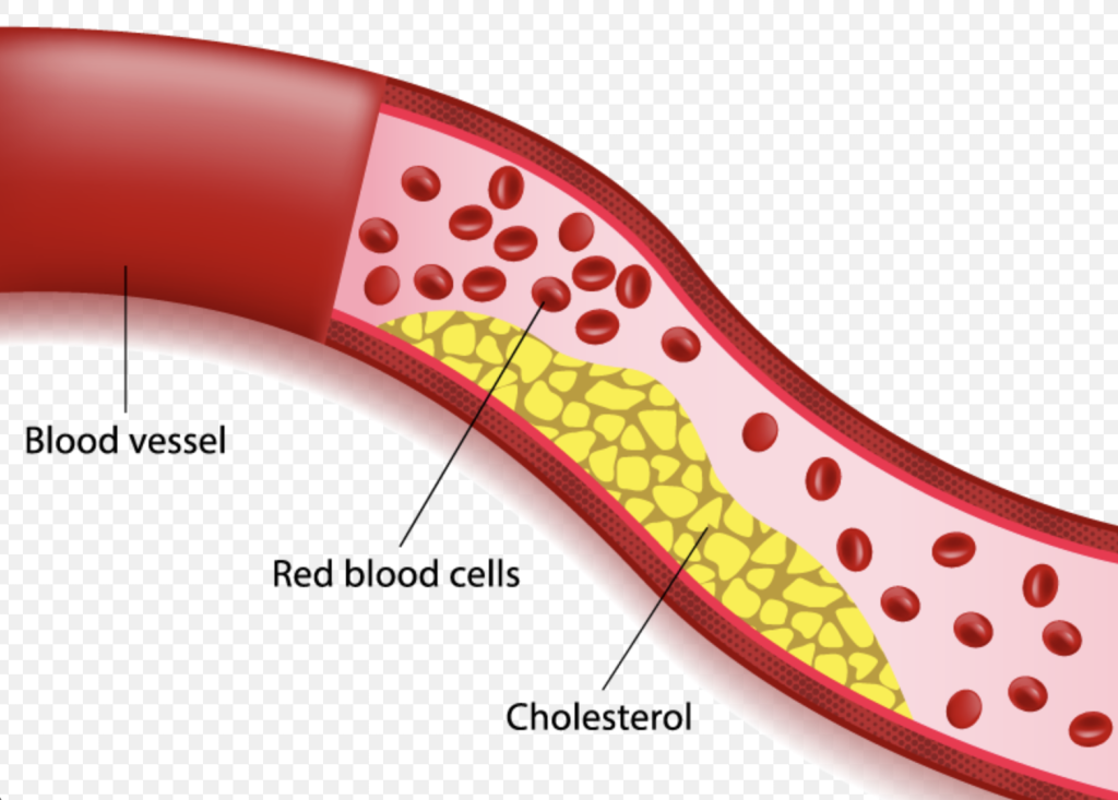 Dyslipidemia treatment - Dr. Debabrata Sarkar